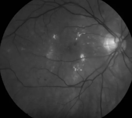 Original angiogram image